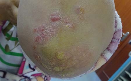 银屑病症状,临沂得银屑病怎么样治疗