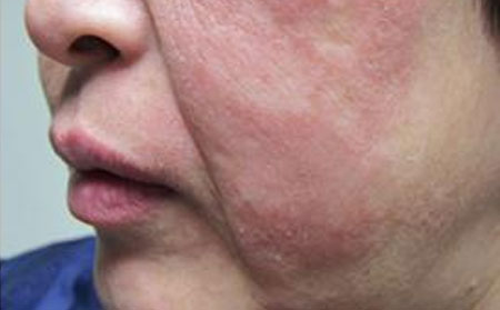 临沂的银屑病医院专科哪家好脸上银屑病症状