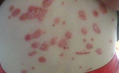 银屑病的易发人群都有哪一些呢