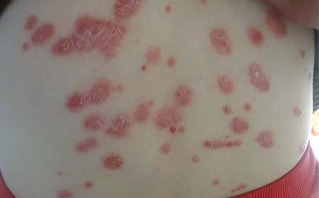 临沂哪个医院看银屑病专业银屑病易发人群