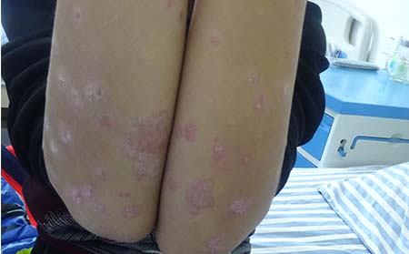 临沂轻度银屑病用什么方法能治好轻度银屑病加重