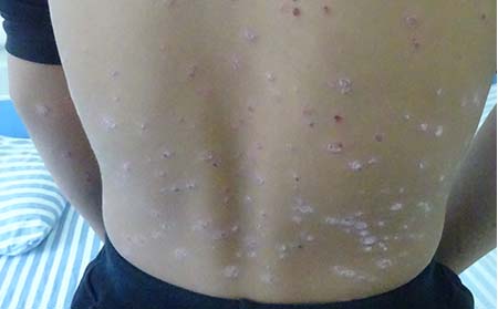 临沂得银屑病在哪里治疗比较好银屑病的初期症状