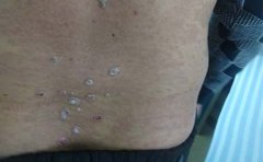 哪一类人群容易得上牛皮癣这种疾病呢