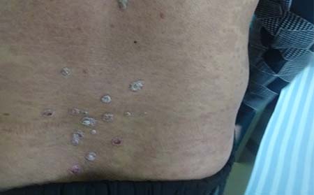 临沂市银屑病治疗的价格哪类人容易得牛皮癣