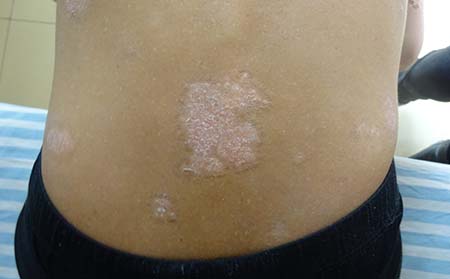 临沂轻度银屑病治疗到那家好轻度斑块型银屑病治疗