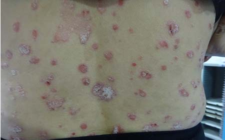 临沂背部牛皮癣去哪治疗好背部牛皮癣有什么症状