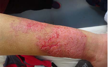 临沂儿童患银屑病病因