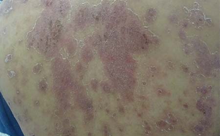 临沂哪个医院治疗牛皮癣疗效好牛皮癣同形反应