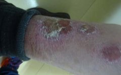 临沂市治疗银屑病价格