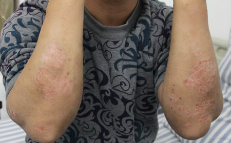 临沂治疗皮肤病医院