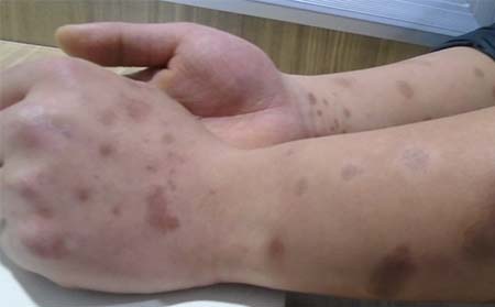 银屑病患者护理方法