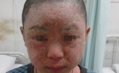 这七种食物牛皮癣患者尽量避免食用