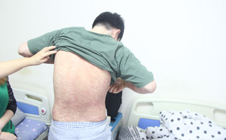 银屑病的护理方法