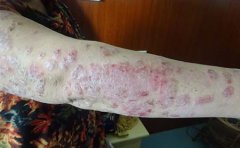 银屑病患者在日常生活中的饮食禁忌是什么