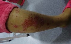 临沂银屑病患者要谨防治疗误区