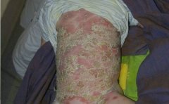 秋季应该注意的银屑病护理方法