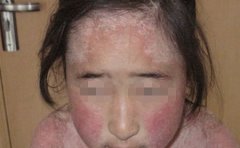 面部长银屑病该怎么办