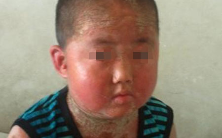 银屑病饮食禁忌