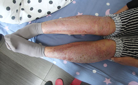 银屑病治疗方法