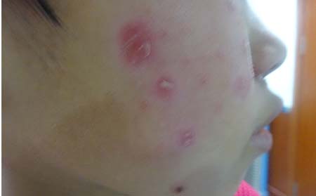 银屑病的危害有什么