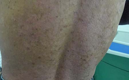 银屑病的诱因有什么