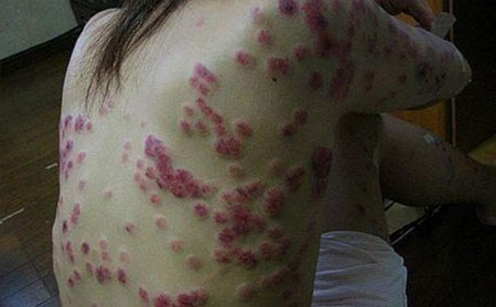 诱发银屑病的原因