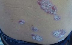 日常生活中对银屑病护理事项有哪些