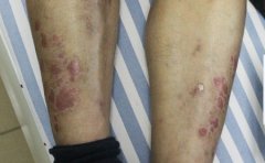 临沂银屑病患者是否能传染呢