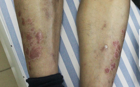 银屑病的诱因有什么