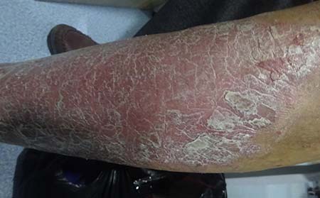 诱发牛皮癣的原因