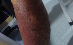 临沂专门治疗银屑病医院分享护理要点