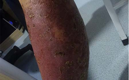 银屑病护理方法