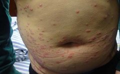 临沂银屑病医院讲解身上长银屑病什么样