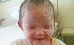 儿童银屑病治疗应注意的事项