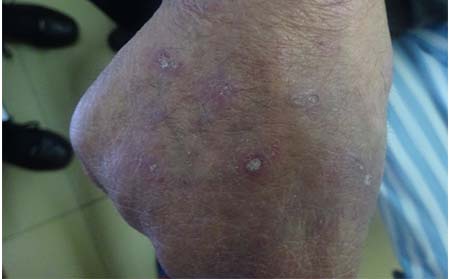 银屑病饮食禁忌