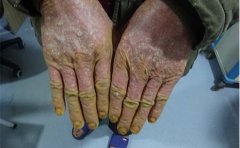 关节病型银屑病症状如何及时发现