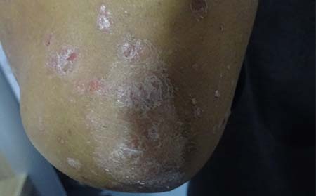 银屑病的治疗方法