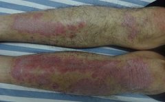 银屑病是否会出现传染