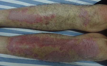 银屑病会不会传染