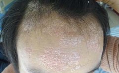 长银屑病有什么样的具体表现