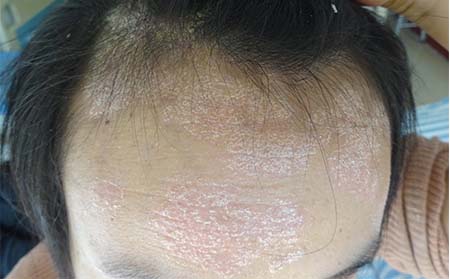 银屑病症状有什么