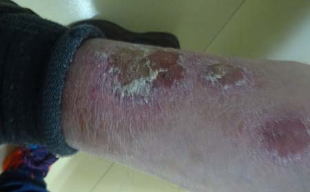 银屑病治疗方法