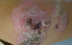 临沂银屑病的护理方法有哪些