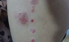 临沂银屑病如何预防皮损扩散呢