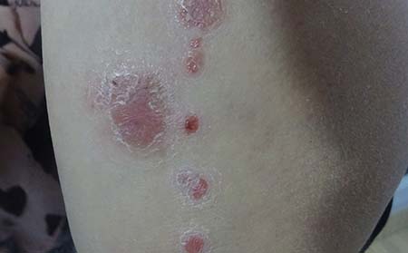 银屑病的预防措施