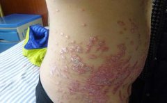 银屑病发病时的身体特点