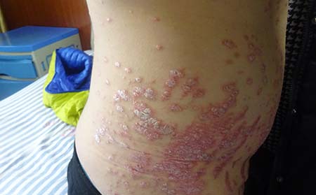 银屑病症状有什么