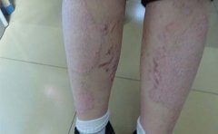身上长银屑病怎么护理呢