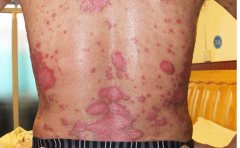 患上牛皮癣之后应该怎么处理好