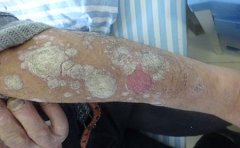 牛皮癣患者如何饮食能保持健康